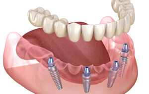 a 3D depiction of all-on-4 implants