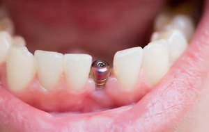 abutment for dental implant