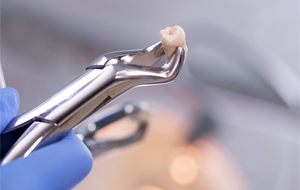 Dentist holding an extracted tooth 