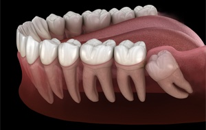Model of an impacted wisdom tooth 