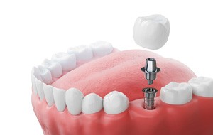 Dental implant, abutment, and crown between natural teeth