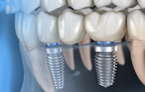 Illustration of two dental implants in jawbone