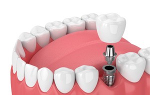 Digital illustration of a single tooth dental implant in Jacksonville being placed