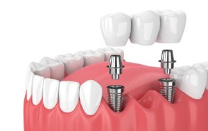 Digital illustration of an implant bridge replacing multiple missing teeth in Jacksonville