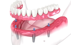 a 3D example of all-on-4 dental implants