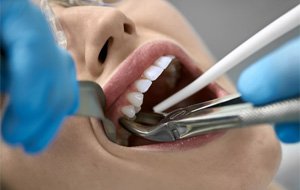 tooth extraction cost of root canal in Jacksonville           