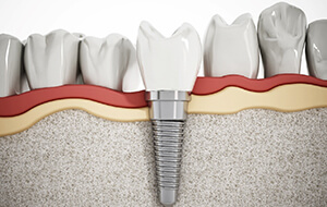 Single dental implant and crown next to natural teeth