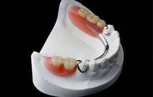 Partial dentures example