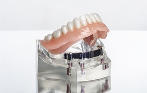 Model smile with implant retained denture