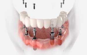 a digital illustration of permanent implant dentures