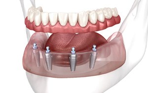 a digital illustration of removable implant dentures