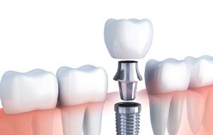 Digital illustration of a single tooth dental implant in Jacksonville being placed