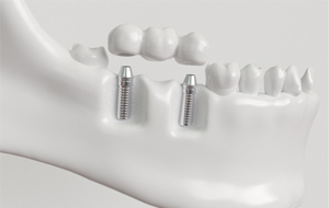 implant bridge model