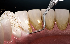 Illustration of tool being used to scale teeth