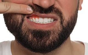 Man pulling up his lip, concerned about gum disease