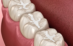 Illustration of dental sealant on teeth