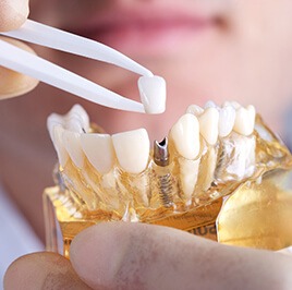 closeup of dental implants model