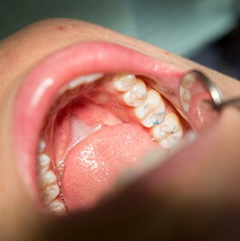 closeup of mouth showing dental fillings