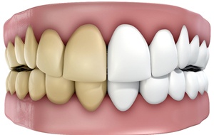 stained teeth