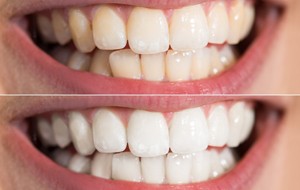 Before and after teeth whitening