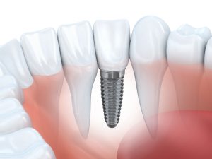 dental implant dentist in jacksonville, fl discusses how they work