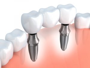 A diagram of an implant-supported bridge.