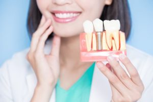 woman holding model of dental implant