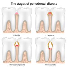 Illustration of the stages of gum disease