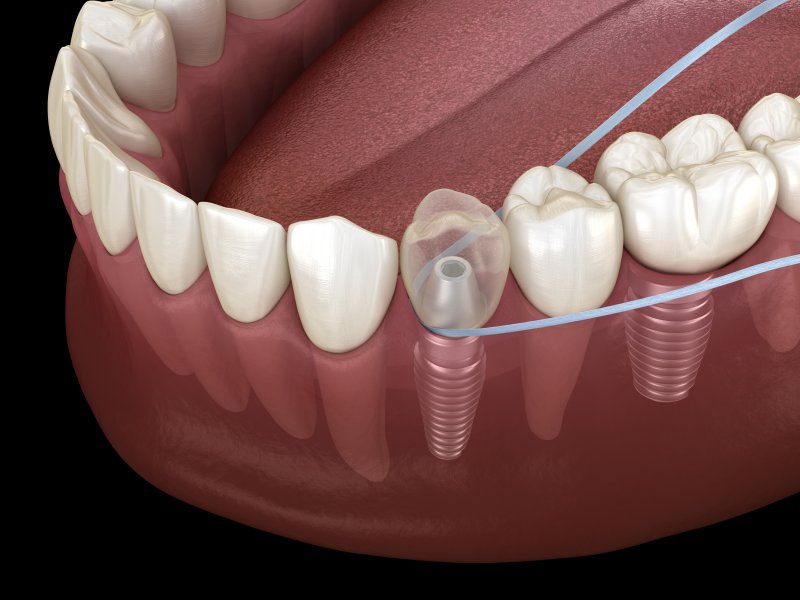 Flossing dental implant