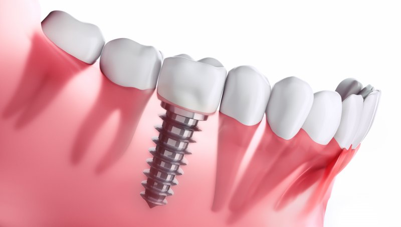 a digital image of a single tooth dental implant sitting on the lower arch between two healthy teeth