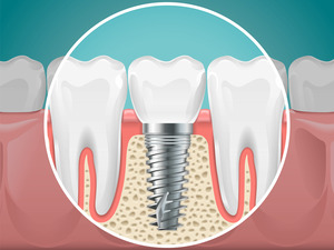 Image of a dental implant