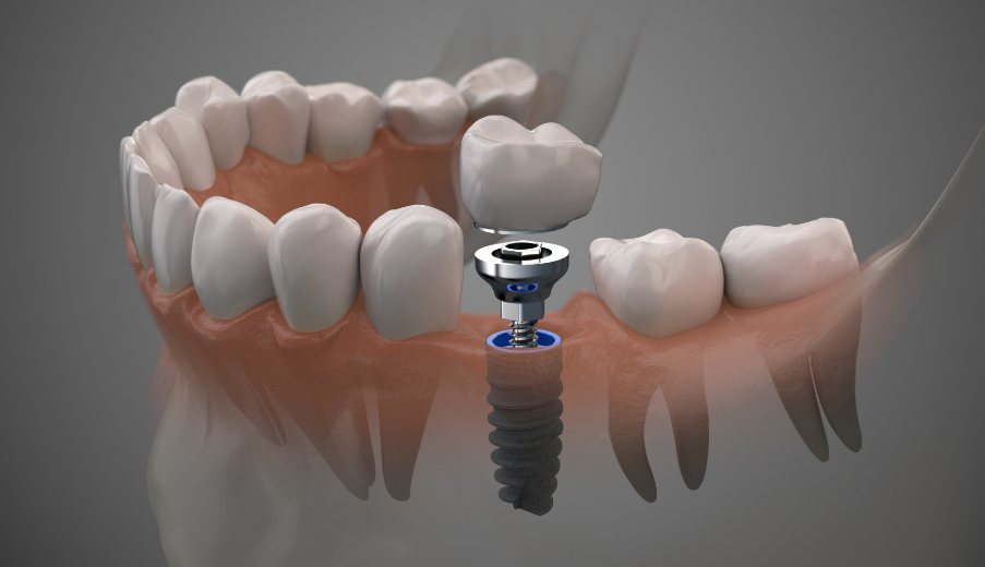 3D image of a dental implant